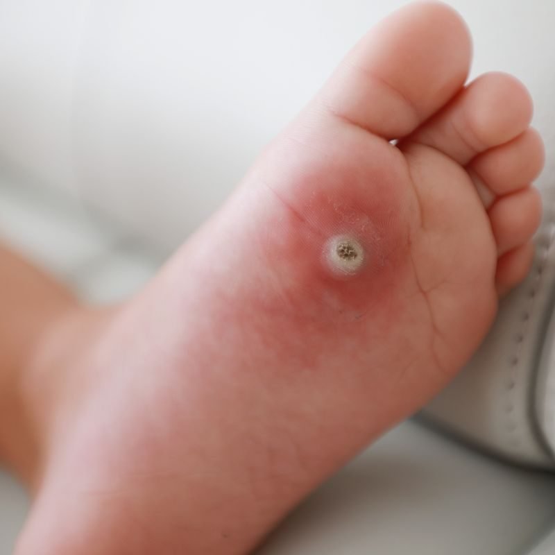 Verruga plantar na sola do pé antes do tratamento podológico